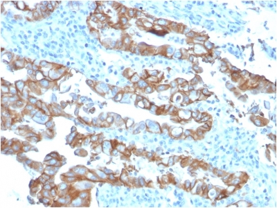 Formalin-fixed, paraffin embedded human colon carcinoma sections stained with 100 ul anti-TROP2 (clone TACSTD2/2153) at 1:300. HIER epitope retrieval prior to staining was performed in 10mM Citrate, pH 6.0.